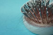 hair-loss