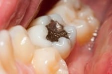 Amalgam filling